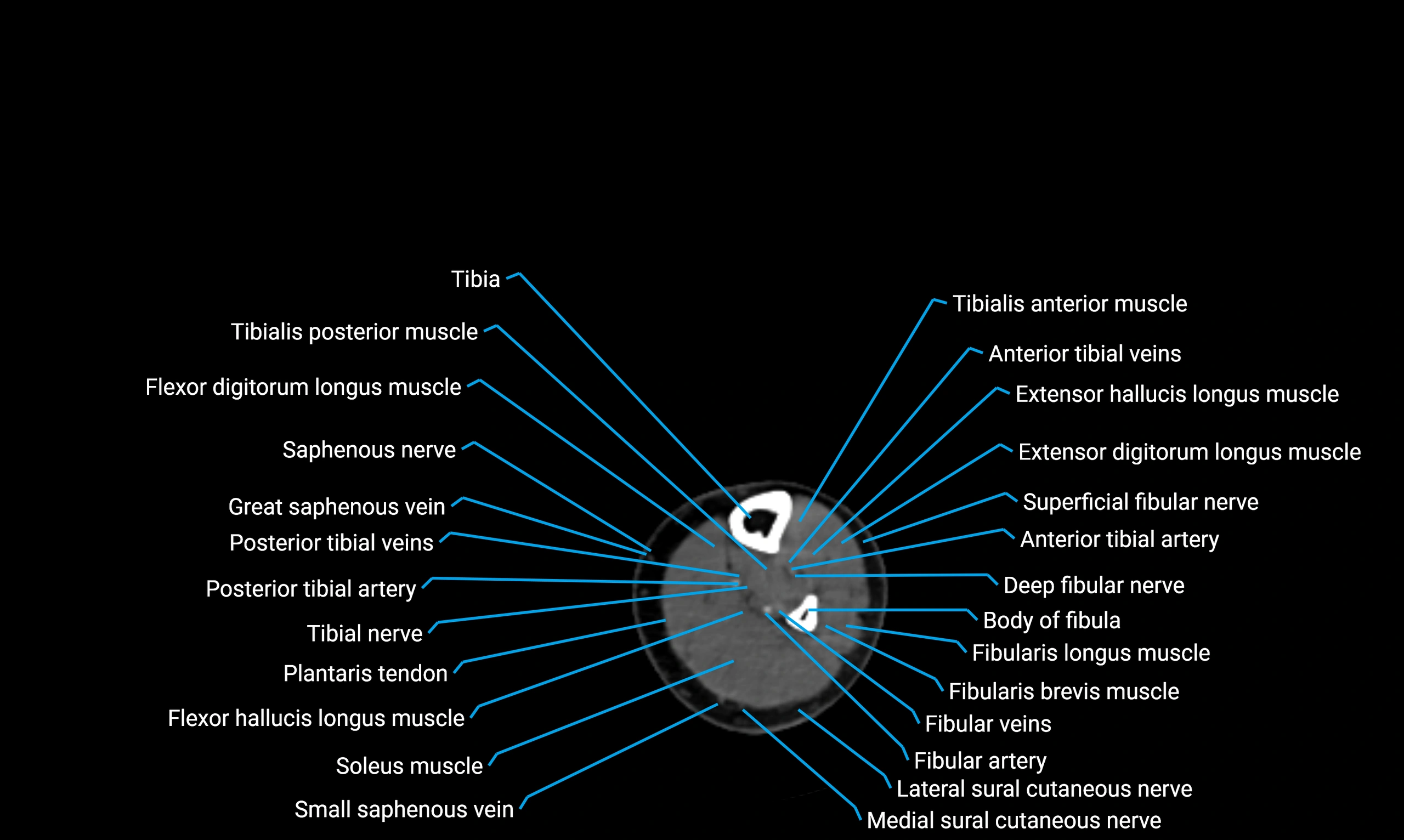 CT lower limb axial cross sectional anatomy labelled image 126 (2).webp